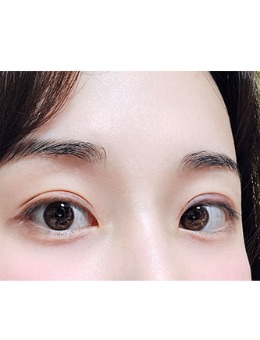 韩国yellow整形埋线法双眼皮+开上眼角手术案例