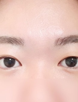韩国yellow整形眼皮一单一双做双眼皮对比照