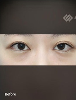 韩国普拉美斯埋线双眼皮手术对比照