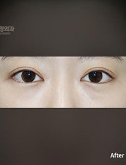 韩国普拉美斯埋线双眼皮手术对比照