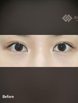 韩国普拉美斯整形“埋线法双眼皮”手术案例