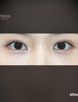 韩国普拉美斯整形“埋线法双眼皮”手术案例
