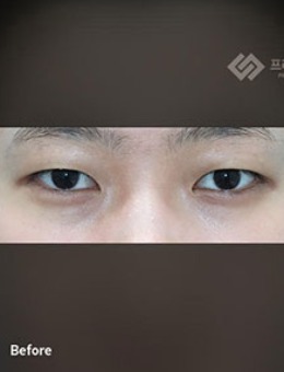 -韩国普拉美斯单眼皮打造双眼皮手术日记