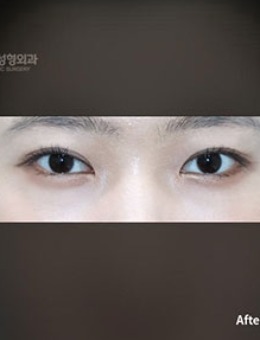 韩国普拉美斯单眼皮打造双眼皮手术案例