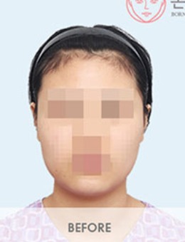 韩国BornDi整形外科下颌角+颧骨整形手术对比照_术前