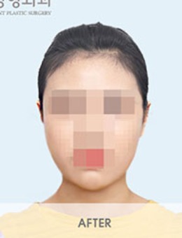 韩国BornDi整形外科下颌角+颧骨整形手术对比照_术后