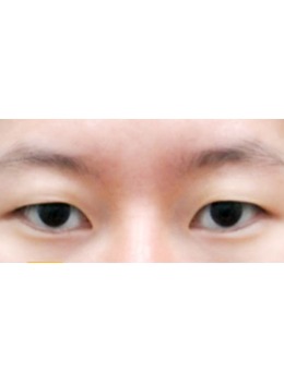 -韩国yellow整形医院做双眼皮手术恢复照