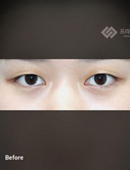 韩国普拉美斯整形埋线双眼皮对比照