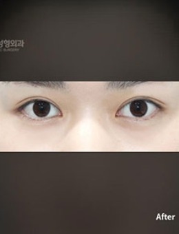 韩国普拉美斯整形埋线双眼皮对比照