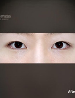 韩国普拉美斯自然流畅性埋线双眼皮对比照