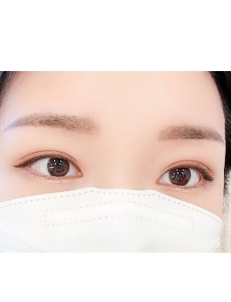 韩国yellow整形做埋线双眼皮恢复3~6个月照片_术后