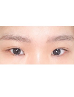 -韩国yellow整形埋线双眼皮+开眼角+眼尾下至综合手术照片