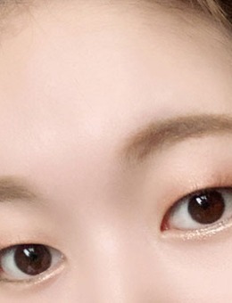 韩国yellow自然粘连双眼皮+上眼角手术对比照_术前