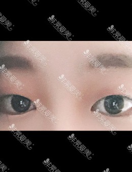 -韩国icon整形埋线双眼皮手术对比照