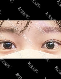 -韩国icon整形埋线双眼皮手术对比照