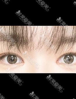 韩国icon整形非切开眼肌矫正+前眼角手术案例_术后