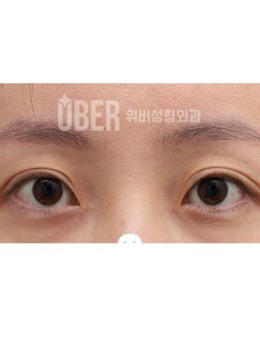 -韩国玉芭uber整形修复双眼皮+眼提肌手术对比照
