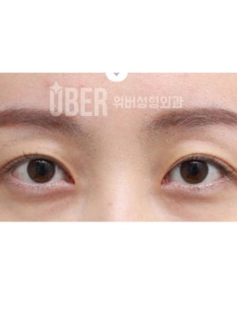 韩国玉芭uber整形修复双眼皮+眼提肌手术对比照