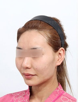 韩国美迪莹颧骨+下颌角整形6个月对比照片