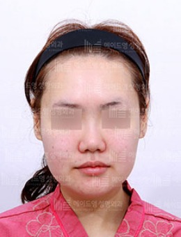 韩国美迪莹“宽脸型”下颌角整形手术对比照