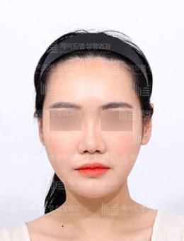 -韩国美迪莹“宽脸型”下颌角整形手术对比照