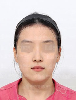 韩国美迪莹整形“下巴”重塑V脸轮廓，三组角度对比都很能打！