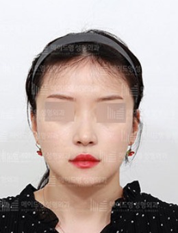 韩国美迪莹整形“下巴”重塑V脸轮廓，三组角度对比都很能打！
