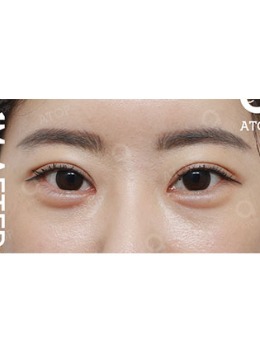 -韩国爱她整形双眼皮手术前后对比照片