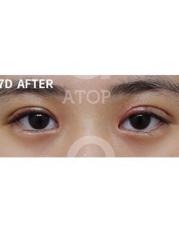 韩国爱她整形双眼皮整形手术三组恢复照分享！_术后