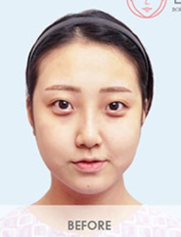 韩国BornDi整形双眼皮+隆鼻+双下巴吸脂手术对比照