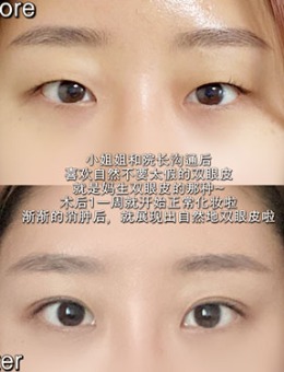 韩国dr朵眼部全切双眼皮+脂肪去除手术对比照
