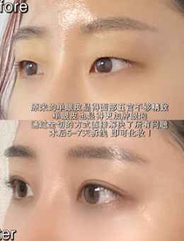 -韩国dr朵眼部全切双眼皮+脂肪去除手术对比照