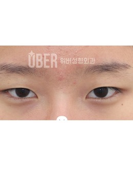 -韩国玉芭uber自然流畅双眼皮+眼肌手术对比照