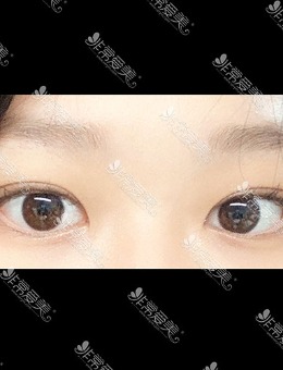 韩国icon三重埋线双眼皮+去眼内脂肪对比照