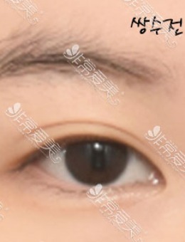 韩国icon眼综合：双眼皮+开前眼角+上眼角对比照