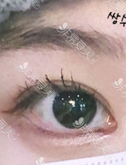 韩国icon眼综合：双眼皮+开前眼角+上眼角对比照