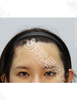 韩国zell整形额头整形+眼综合手术对比照