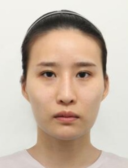 韩国note整形轮廓三件套+隆鼻手术对比照