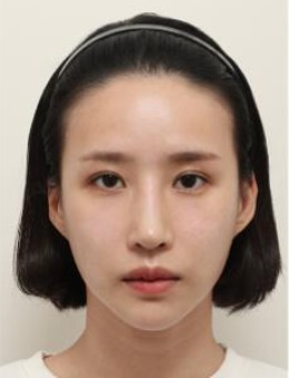 韩国note整形轮廓三件套+隆鼻手术对比照_术后