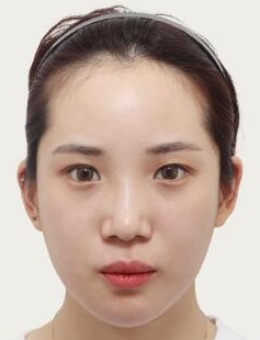 韩国note整形颧骨+下颌角手术对比案例