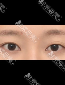 韩国icon埋线双眼皮修复手术对比照_术前