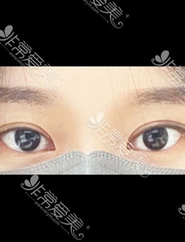 韩国icon埋线双眼皮修复手术对比照_术后