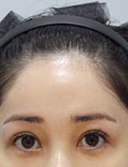 韩国zell整形额头提升+埋线双眼皮手术对比照_术后