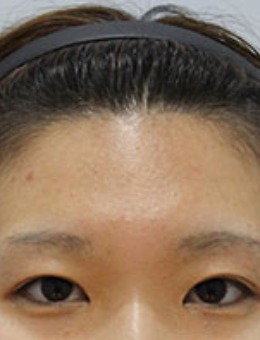 韩国zell整形额头提升+切开双眼皮修复照片