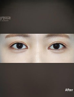 韩国普拉美斯埋线自然流畅双眼皮修复+前眼角对比照_术后