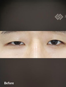 韩国普拉美斯眼提肌+双眼皮手术对比照