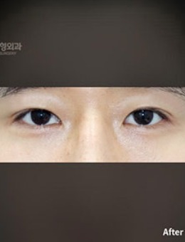 韩国普拉美斯眼提肌+双眼皮手术对比照_术后