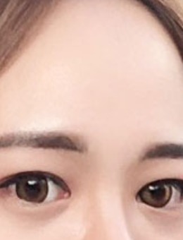 韩国yellow整形切开双眼皮+开眼角手术对比照