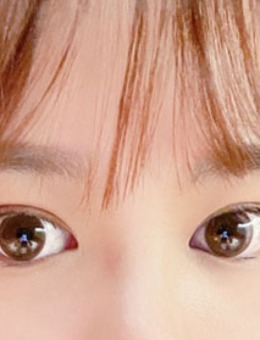 韩国yellow整形切开双眼皮+开眼角手术对比照_术后