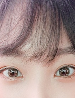 韩国yellow眼睛一单一双整形手术对比照